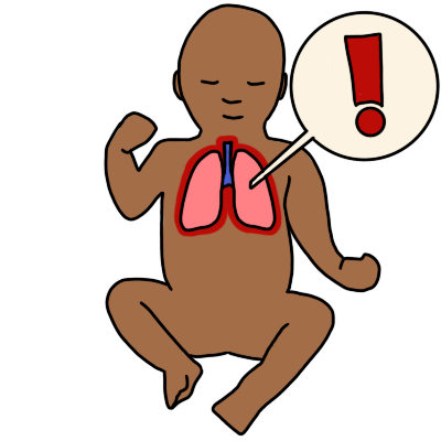 an infant with brown skin and pink lungs outlined in red. a white circle with a red exclamation mark in it connects to the lungs.